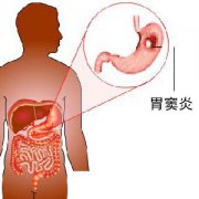【病因】胃窦炎的原因有哪些？