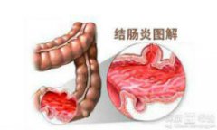 结肠炎的病因有哪些？